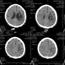 अच्छा दाम केएनडी- DRYTEC-3000 लेजर प्रिंटर के लिए 28 सेमी * 35 सेमी मेडिकल फिल्म एक्सरे पेपर ऑनलाइन