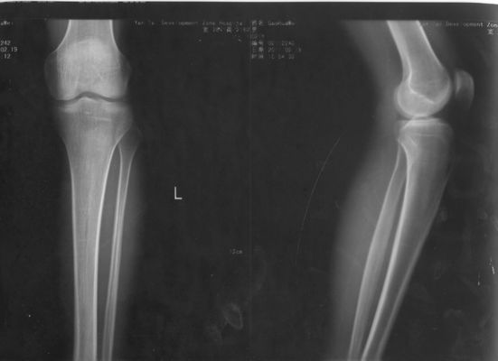 अच्छा दाम केएनडी-डीआरईईसीईसी -4000 केएनडी-के के लिए 32 सेमी * 43 सेमी एक्सरे पेपर मेडिकल लेजर इमेजिंग फिल्म ऑनलाइन