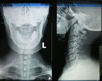 अच्छा दाम 10in * 14in कोनिडा मेडिकल ड्राई इमेजिंग फिल्म KND-F फॉर फ़ूजी 3000, 2000, 1000 ऑनलाइन