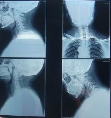 अच्छा दाम रेडियोग्राफिक परीक्षा के लिए KND-K स्क्रैच-प्रतिरोधी मेडिकल पेपर ड्राई इमेजिंग फिल्म ऑनलाइन