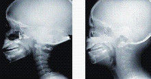 हाई इंक कवरेज एक्स रे डायग्नोस्टिक इमेजिंग, 35 x 43 सेमी लेजर मेडिकल एक्स रे फिल्म